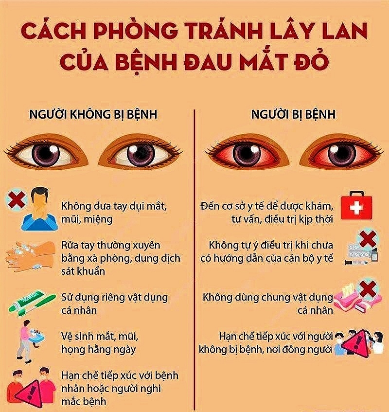 Thái Bình: Tăng cường các biện pháp phòng, chống bệnh đau mắt đỏ
