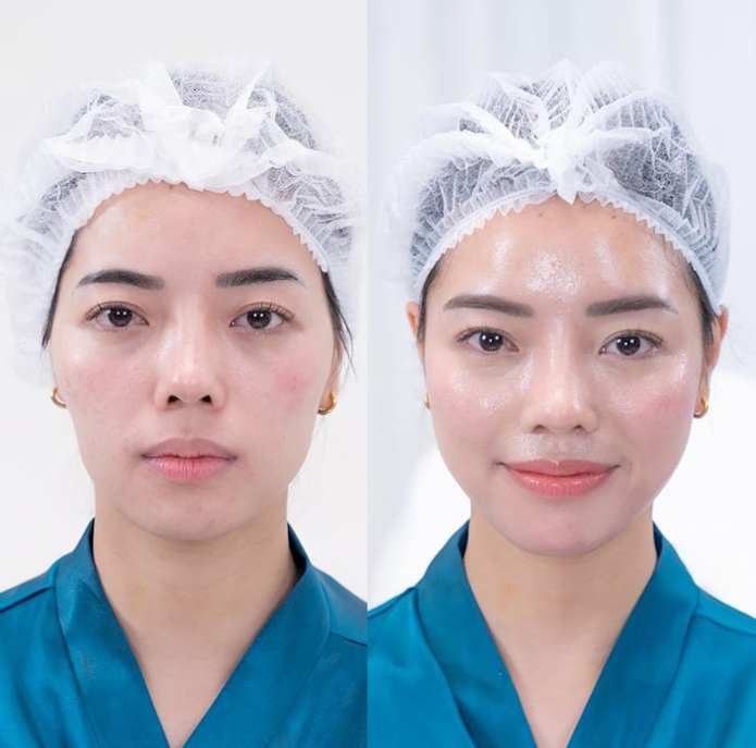 Bác sĩ Thạch Văn Chất mách bạn điều trị lõm hóp bằng công nghệ Maxfill Nano