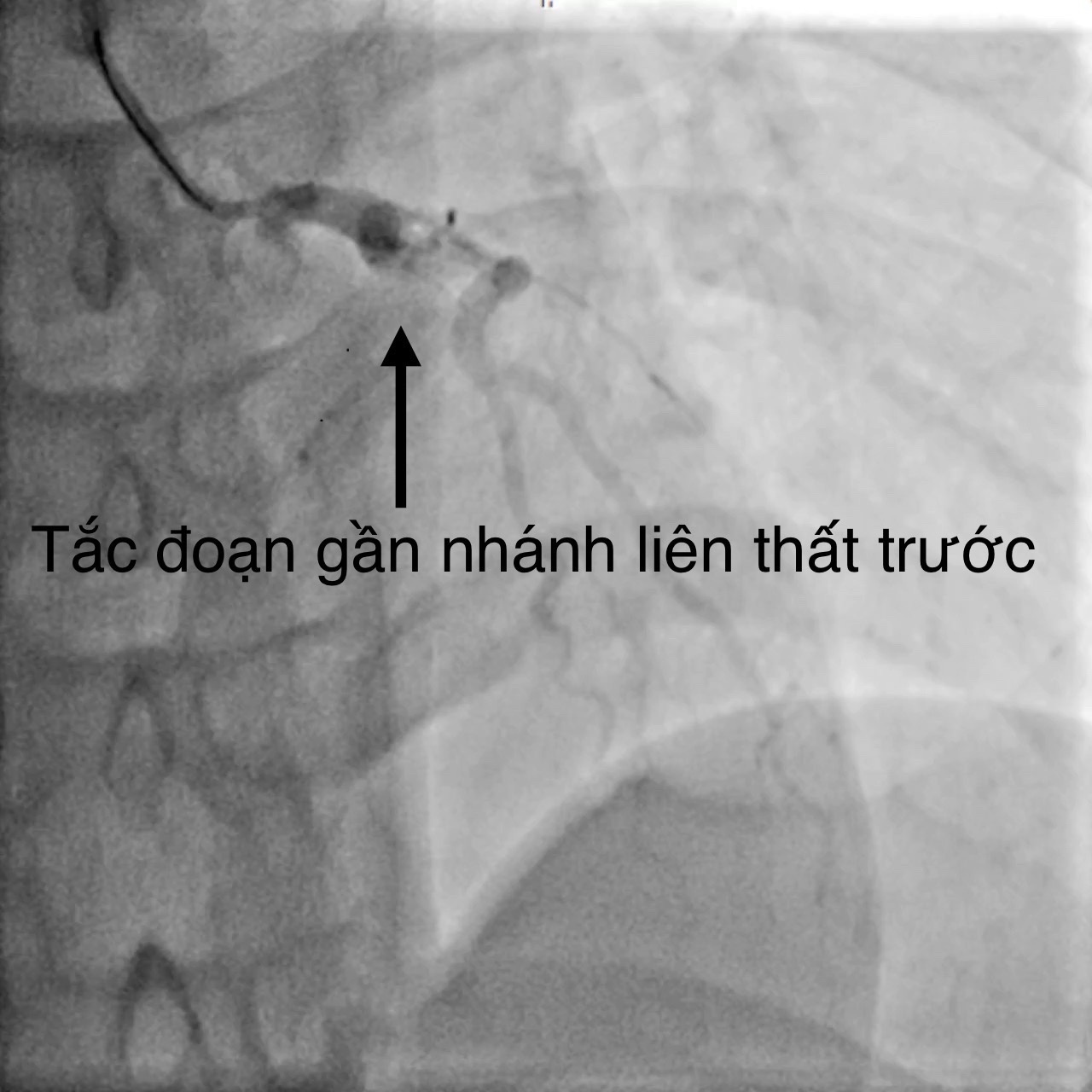 Bệnh viện Đa khoa TW Cần Thơ cứu sống bệnh nhân tai nạn giao thông, nhồi máu cơ tim cấp