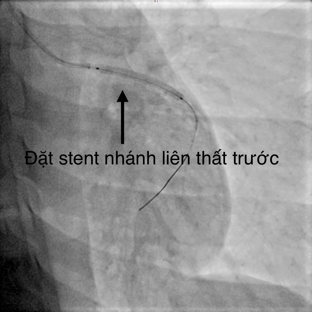 Tình trạng hiện tại: Bệnh nhân tỉnh, không đau ngực, tình trạng sức khỏe ổn định đã được xuất viện ngày 14/02/2024.