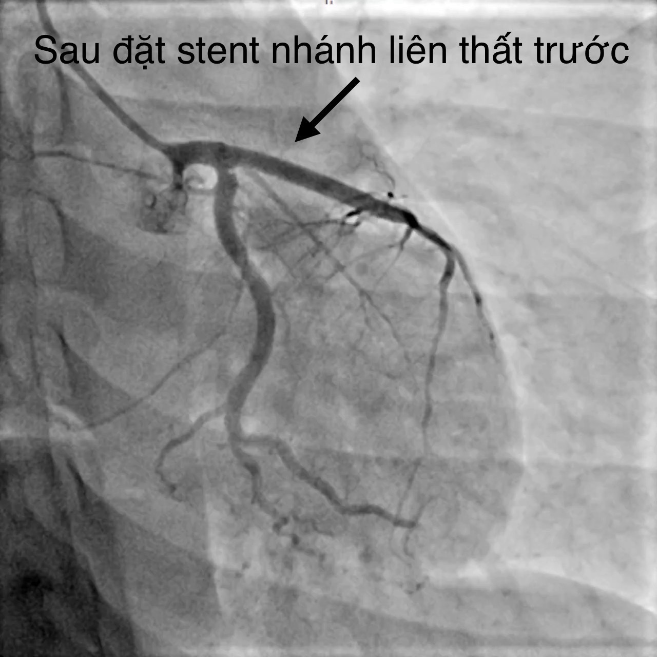 Bệnh viện Đa khoa TW Cần Thơ cứu sống bệnh nhân tai nạn giao thông, nhồi máu cơ tim cấp