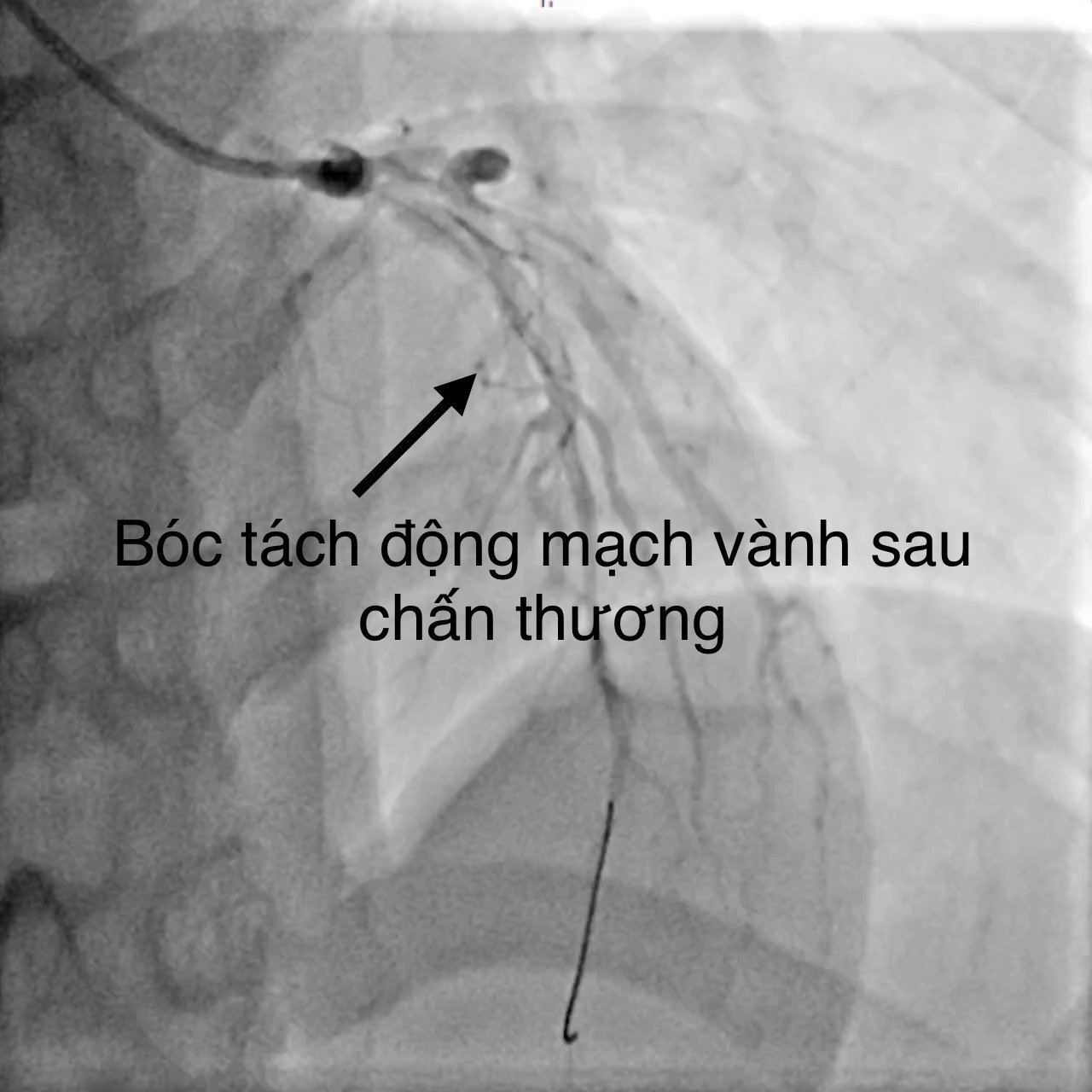 Bệnh viện Đa khoa TW Cần Thơ cứu sống bệnh nhân tai nạn giao thông, nhồi máu cơ tim cấp