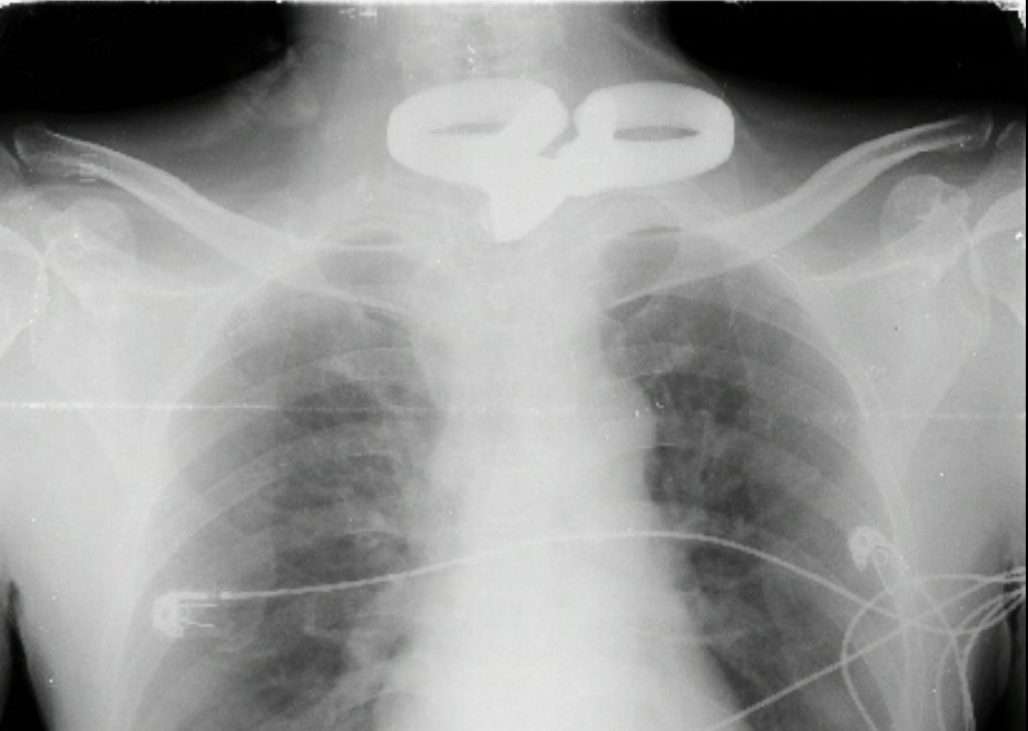 Hình dị vật trên phim Xquang