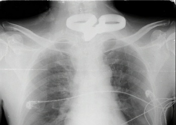 cuu song benh nhan bi keo dai 24 cm dam xuyen co