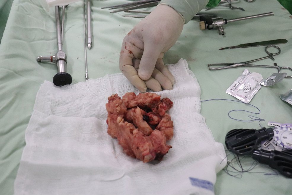 Các phần tử cung bán phần của bệnh nhân được phẫu thuật qua nọi soi