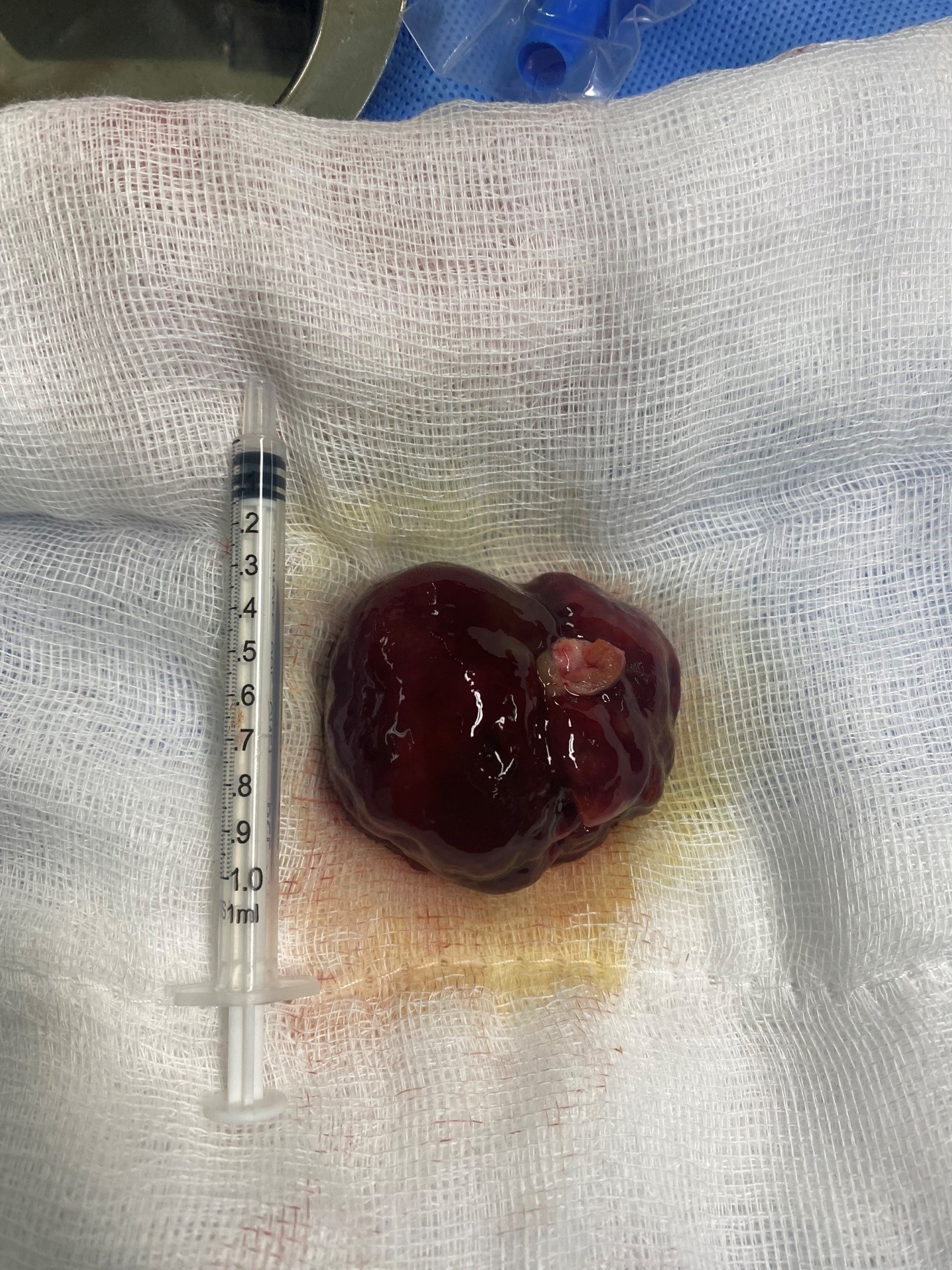 Cần Thơ: Xuyên đêm cứu sống bệnh nhân u tim