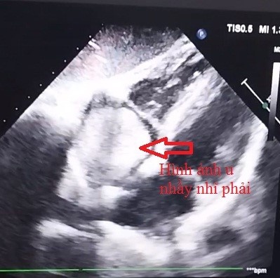 Cần Thơ: Xuyên đêm cứu sống bệnh nhân u tim