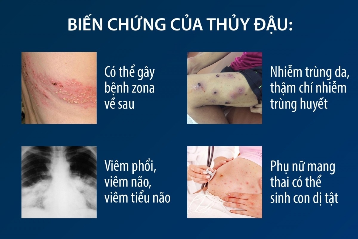 undefined Bệnh thủy đậu và các bệnh đường hô hấp có xu hướng gia tăng tại Hà Nội