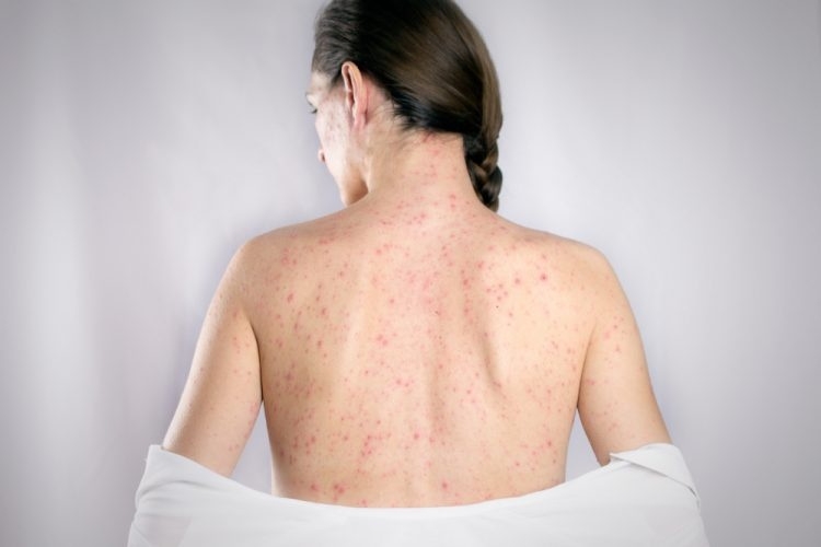 Số ca mắc bệnh sởi, Rubella gia tăng, Viện Vệ sinh dịch tễ Trung ương đề nghị các địa phương phải giám sát chặt và xử lý triệt để. Số ca mắc bệnh sởi, Rubella gia tăng, Viện Vệ sinh dịch tễ Trung ương đề nghị các địa phương phải giám sát chặt và xử lý triệt để.