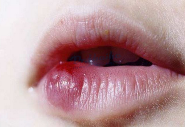 Sử dụng filler kém chất lượng có thể khiến môi bị vón cục sau khi tiêm