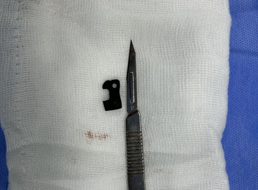 Phẫu thuật lấy mắt xích máy cưa trong ổ bụng bệnh nhân