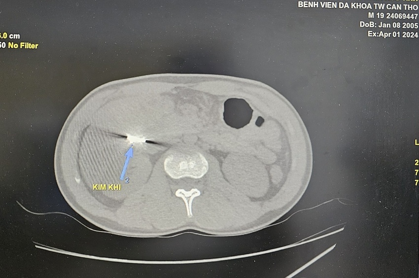 Phẫu thuật lấy mắt xích máy cưa trong ổ bụng bệnh nhân