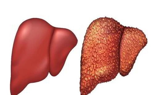 Bị suy gan nặng vì uống thuốc nam không rõ nguồn gốc