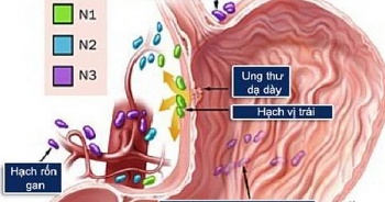chan doan va dieu tri ung thu da day co nhieu buoc tien moi