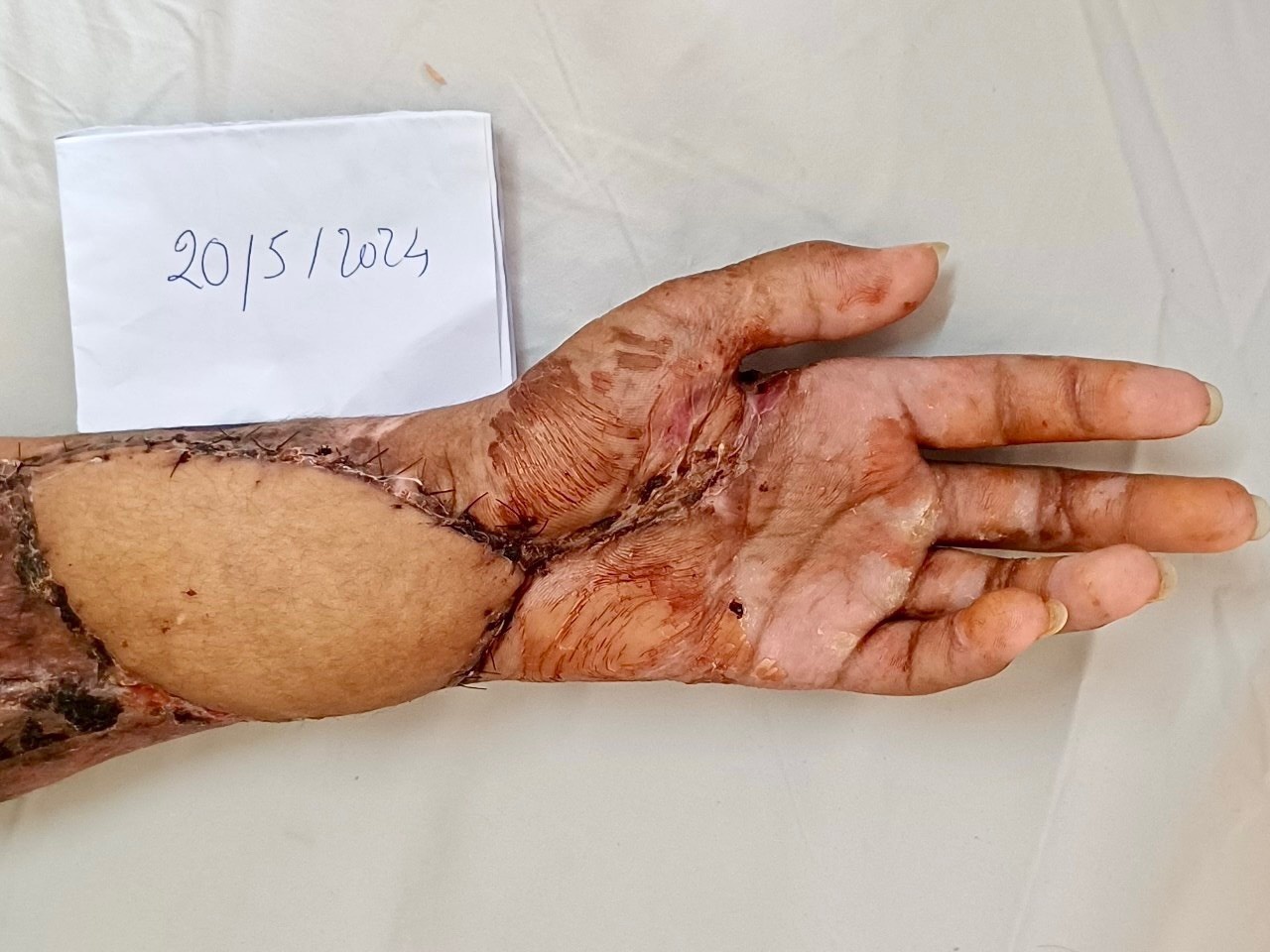 Lần đầu tiên mổ thành công ca vạt da cơ tự do có cuống mạch rời