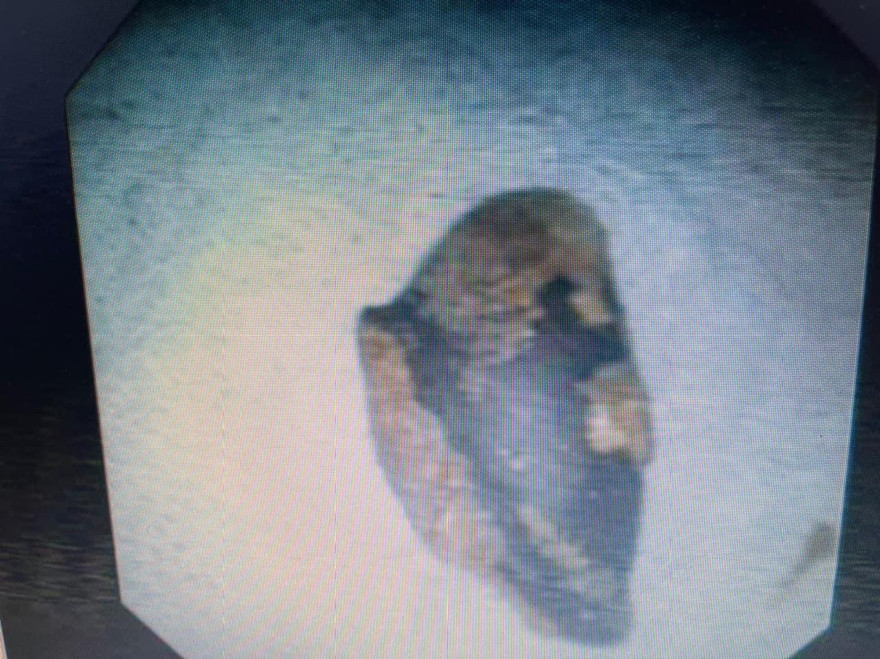 Gắp thành công dị vật ra khỏi phế quản phổi của bệnh nhân