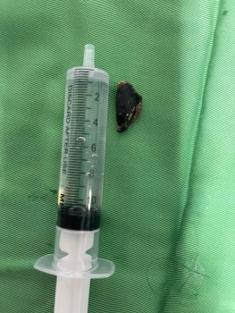 gap thanh cong di vat ra khoi phe quan phoi cua benh nhan