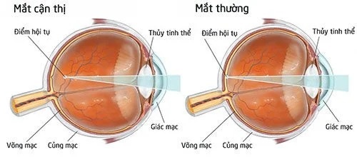 Lưu ý những tổn thương trên đáy mắt ở người cận thị Lưu ý những tổn thương trên đáy mắt ở người cận thị