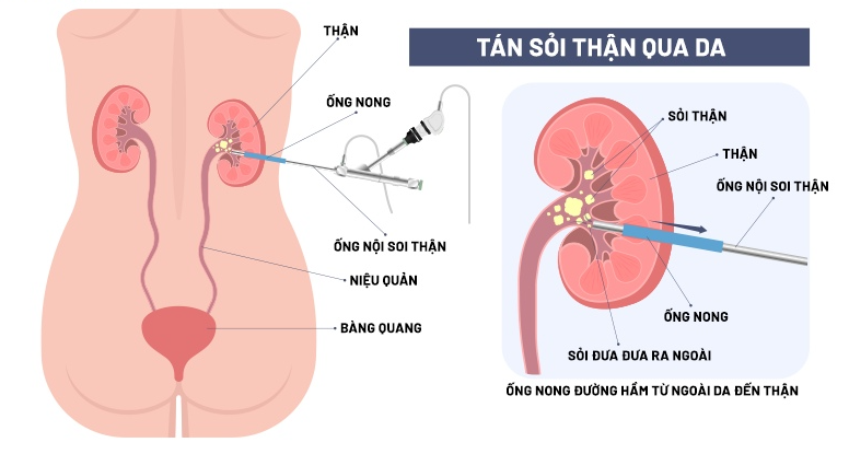 Phương pháp lấy sỏi thận qua da Phương pháp lấy sỏi thận qua da