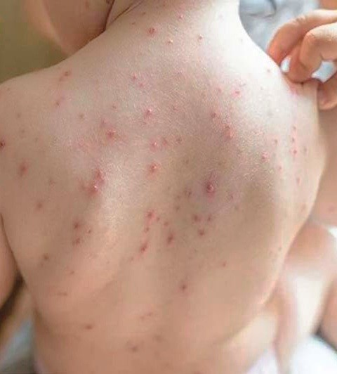 dong nai phat hien ca mac benh dau mua khi thu 4
