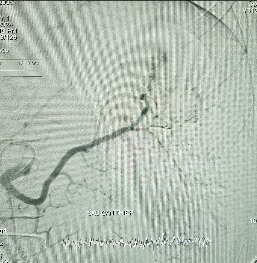 Bệnh viện Đa khoa Trung ương Cần Thơ cứu sống bệnh nhân đa chấn thương nguy kịch Bệnh viện Đa khoa Trung ương Cần Thơ cứu sống bệnh nhân đa chấn thương nguy kịch