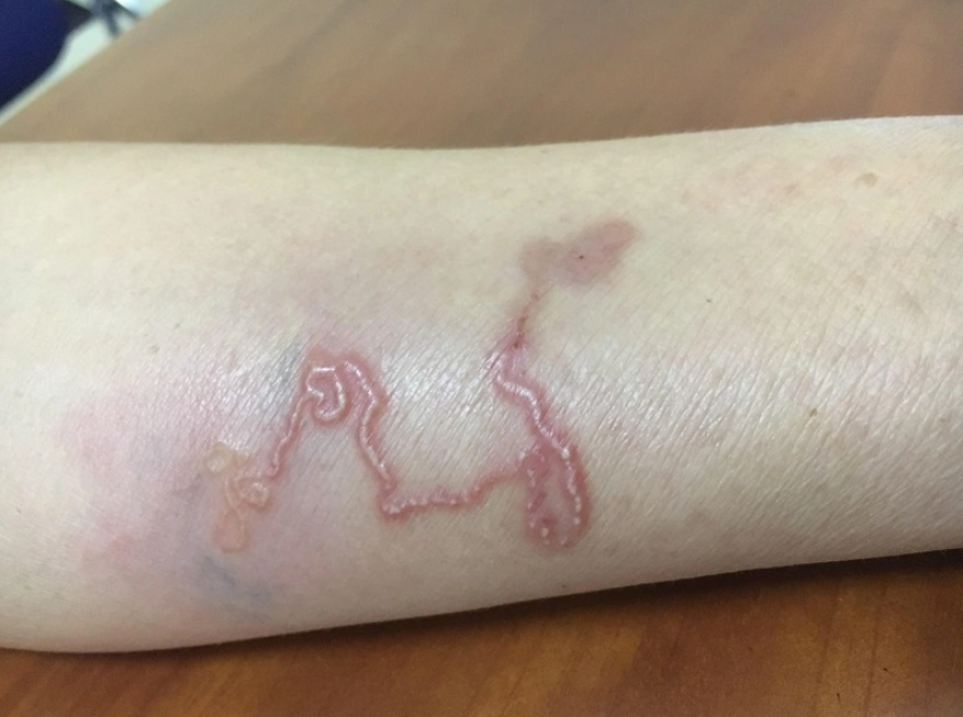 Giun đũa chó Toxocara có thể lây nhiễm cho người với những triệu chứng điển hình. Giun đũa chó Toxocara có thể lây nhiễm cho người với những triệu chứng điển hình.