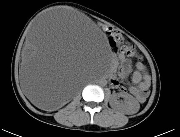 Hình ảnh cắt lớp vi tính của bệnh nhân trước khi phẫu thuật 