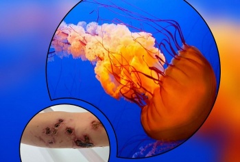 sua lua co the gay viem da den muc hoai tu