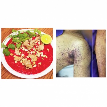 benh lien cau lon rat nguy hiem voi nguoi