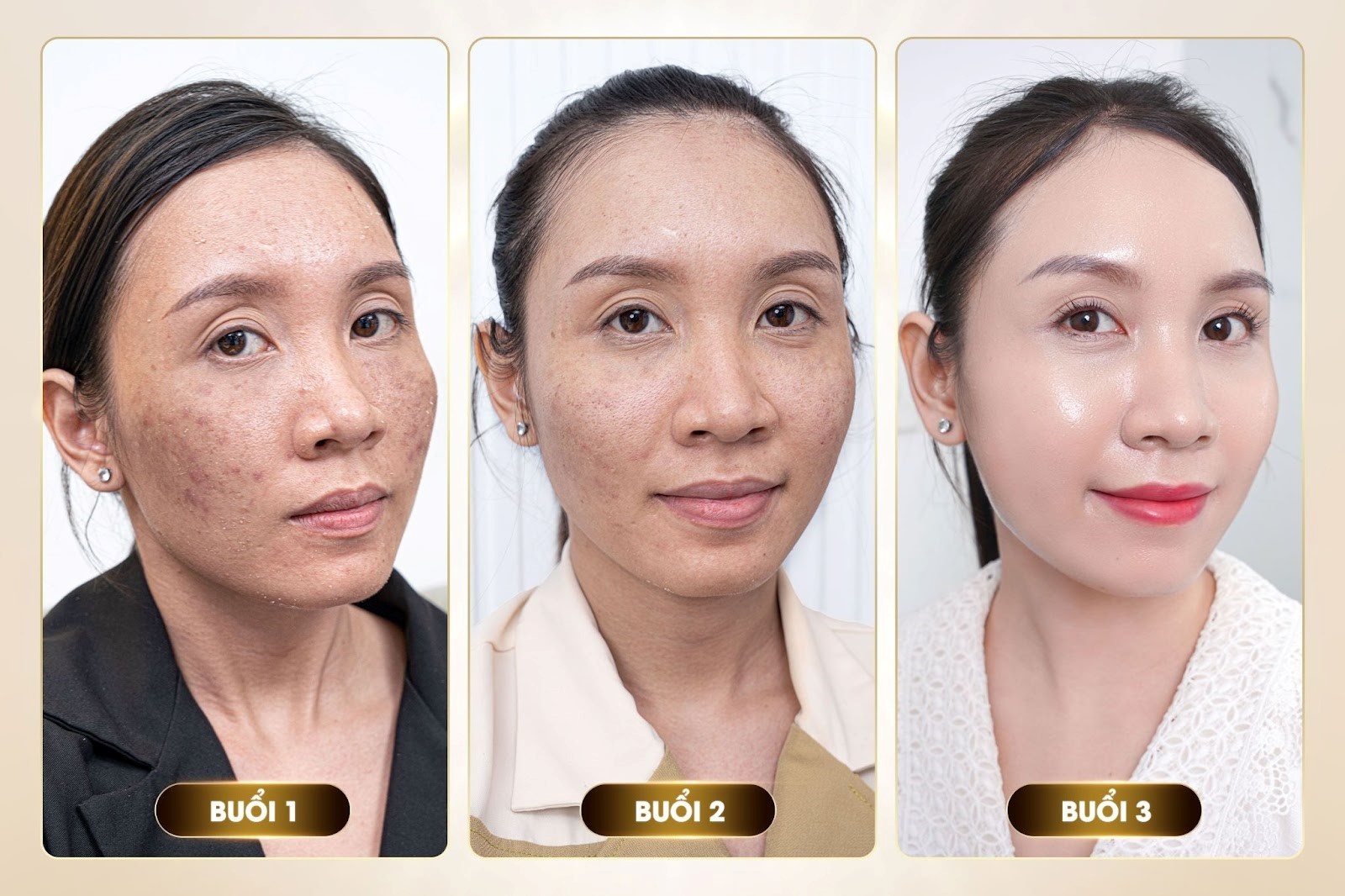 Meso Extra không kim: Cơn sốt làm đẹp vẫn chưa hạ nhiệt