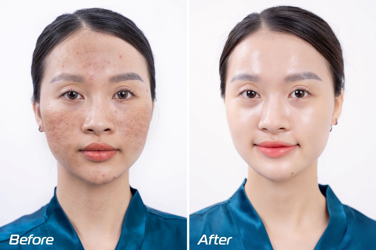 Xu hướng làm đẹp Meso Extra không kim - độc quyền tại bác sĩ Jenny Trúc