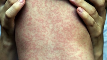 ubnd thanh pho ho chi minh cong bo dich soi