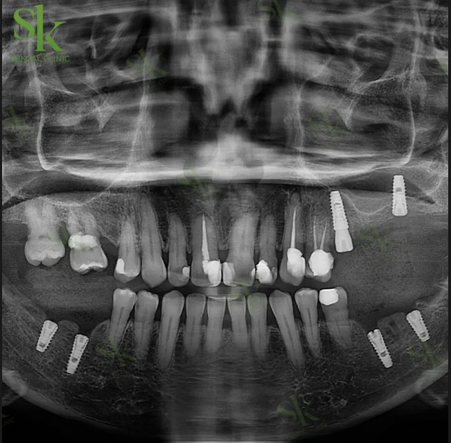 Trồng răng Implant không rạch lợi - kỹ thuật cấy ghép an toàn vượt trội năm 2024