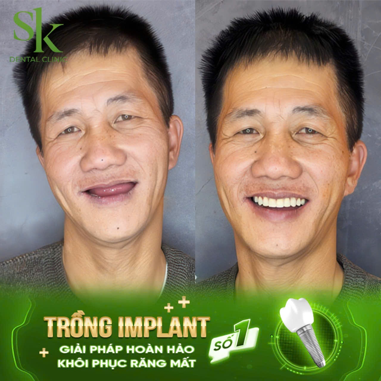 TRỒNG RĂNG IMPLANT KHÔNG RẠCH LỢI - KỸ THUẬT CẤY GHÉP AN TOÀN VƯỢT TRỘI NĂM 2024