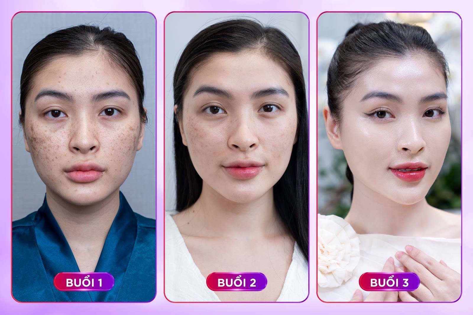 Căng bóng trẻ hoá da Meso Extra không kim: Xu hướng mới cho người “mộ điệu” Căng bóng trẻ hoá da Meso Extra không kim: Xu hướng mới cho người “mộ điệu”