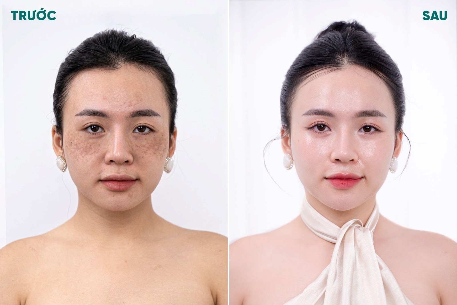 Bác sĩ Huế Anh - tiên phong trong điều trị nám, trẻ hoá da không xâm lấn