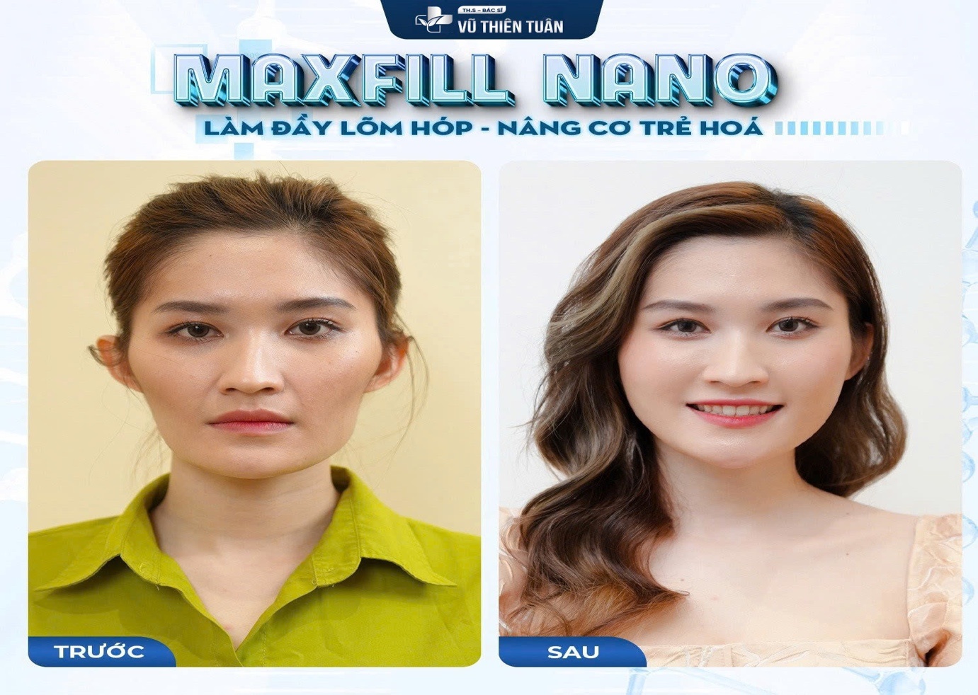 Thạc sĩ - Bác sĩ Vũ Thiên Tuân: MAXFILL NANO – giải pháp làm đầy lõm, hóp an toàn bằng máu tự thân