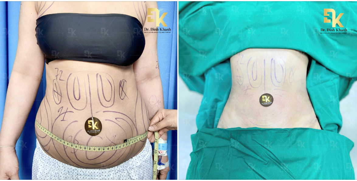 Lần đầu tiên có mặt tại Việt Nam - Công nghệ Q-Lean: Thách thức tất cả mỡ thừa