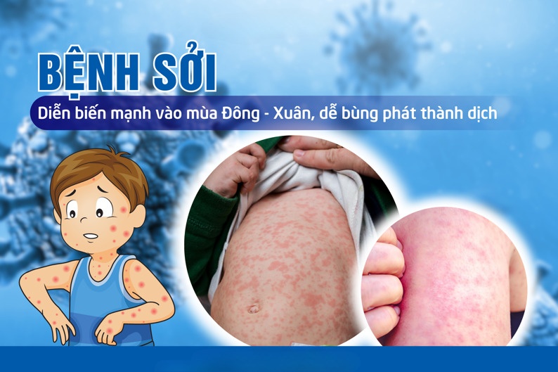 Bệnh sởi là bệnh truyền nhiễm lây lan qua đường hô hấp, đã từng xảy ra những đợt dịch lớn; hiện chưa có thuốc điều trị đặc hiệu. Bệnh sởi là bệnh truyền nhiễm lây lan qua đường hô hấp, đã từng xảy ra những đợt dịch lớn; hiện chưa có thuốc điều trị đặc hiệu.