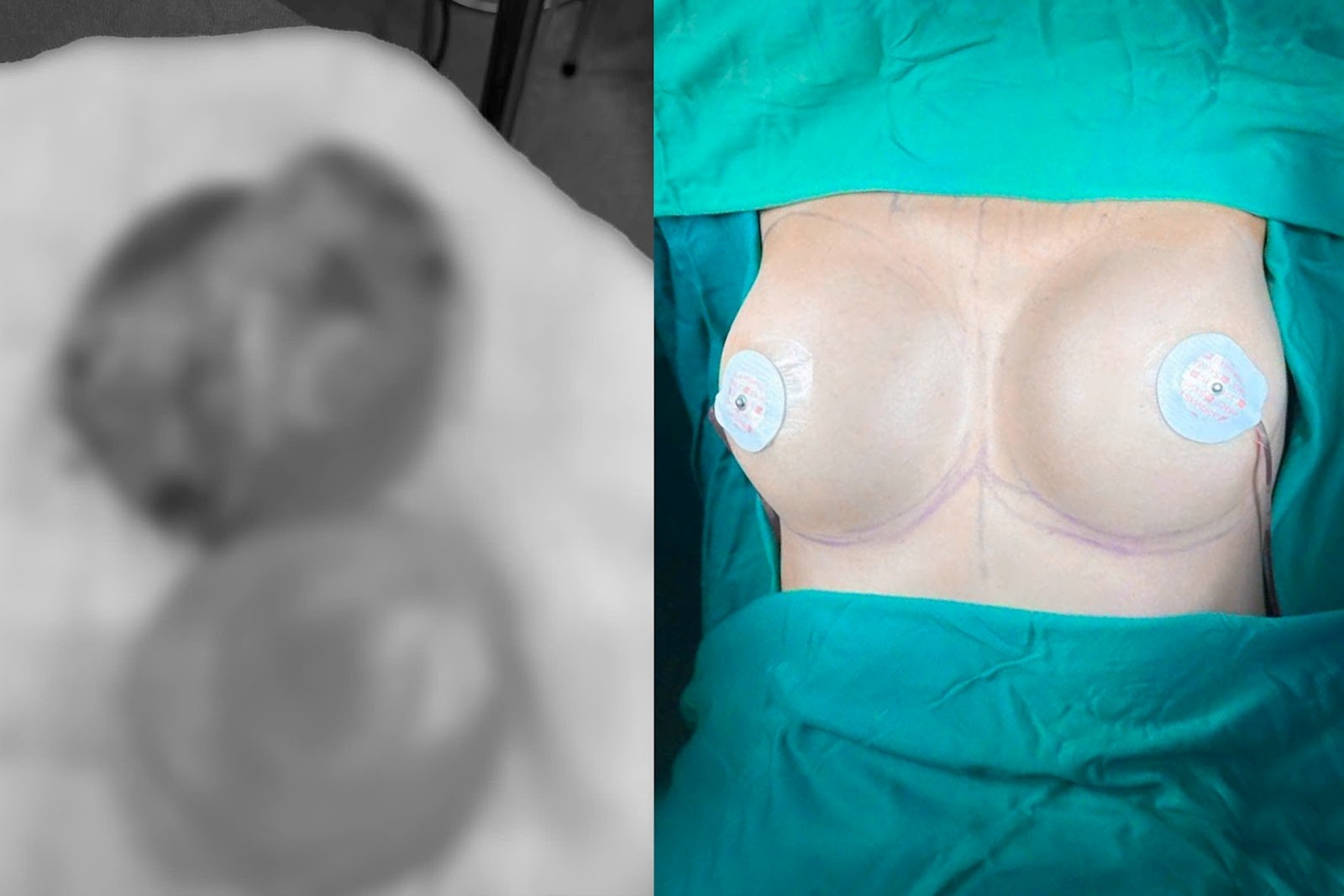 Tai biến thẩm mỹ: Khi ước mơ trở thành ác mộng Tai biến thẩm mỹ: Khi ước mơ trở thành ác mộng