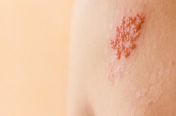 du phong zona o nguoi lon bang vaccine