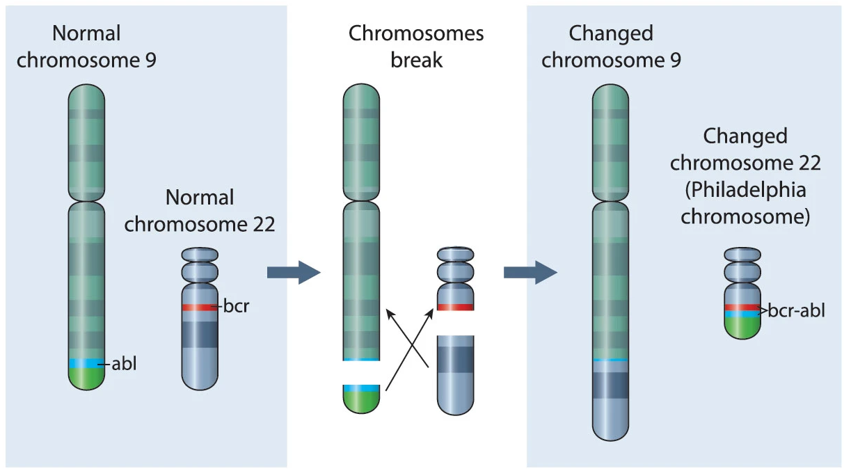 Bệnh bạch cầu tủy xương mãn tính (CML) do chuyển đoạn NST 9 và 22 gây ra. Bệnh bạch cầu tủy xương mãn tính (CML) do chuyển đoạn NST 9 và 22 gây ra.
