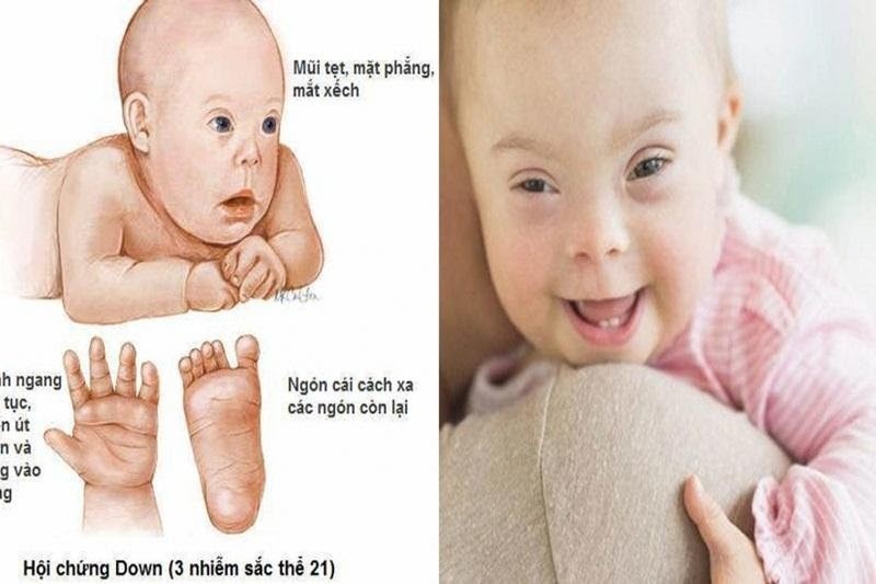 Trẻ bị mắc hội chứng Down thường có các đặc điểm nhận dạng đặc trưng. Trẻ bị mắc hội chứng Down thường có các đặc điểm nhận dạng đặc trưng.