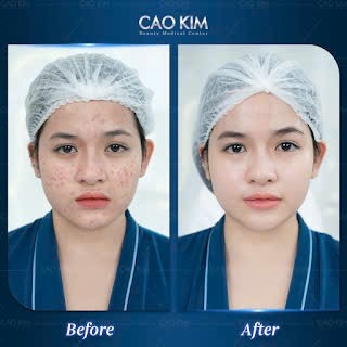 undefined “Không thể tin được khi làn da mình có thể đẹp như bây giờ, mà quan trọng điều trị thời gian rất ngắn thôi. Trộm vía các bác sĩ tại Cao Kim rất nhiệt tình và mát tay. Cho Cao Kim 10 điểm” - Chị Thùy Linh, 35 tuổi chia sẻ