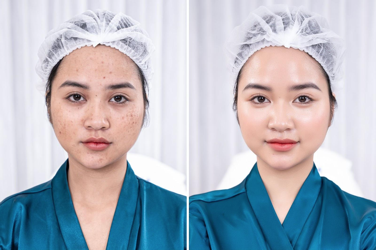 Chị Thu Nga lấy lại diện mạo với làn da mộc, sạch khuyết điểm sau liệu trình Meso Extra không kim bên Phòng khám thẩm mỹ Cao Kim Chị Thu Nga lấy lại diện mạo với làn da mộc, sạch khuyết điểm sau liệu trình Meso Extra không kim bên Phòng khám thẩm mỹ Cao Kim