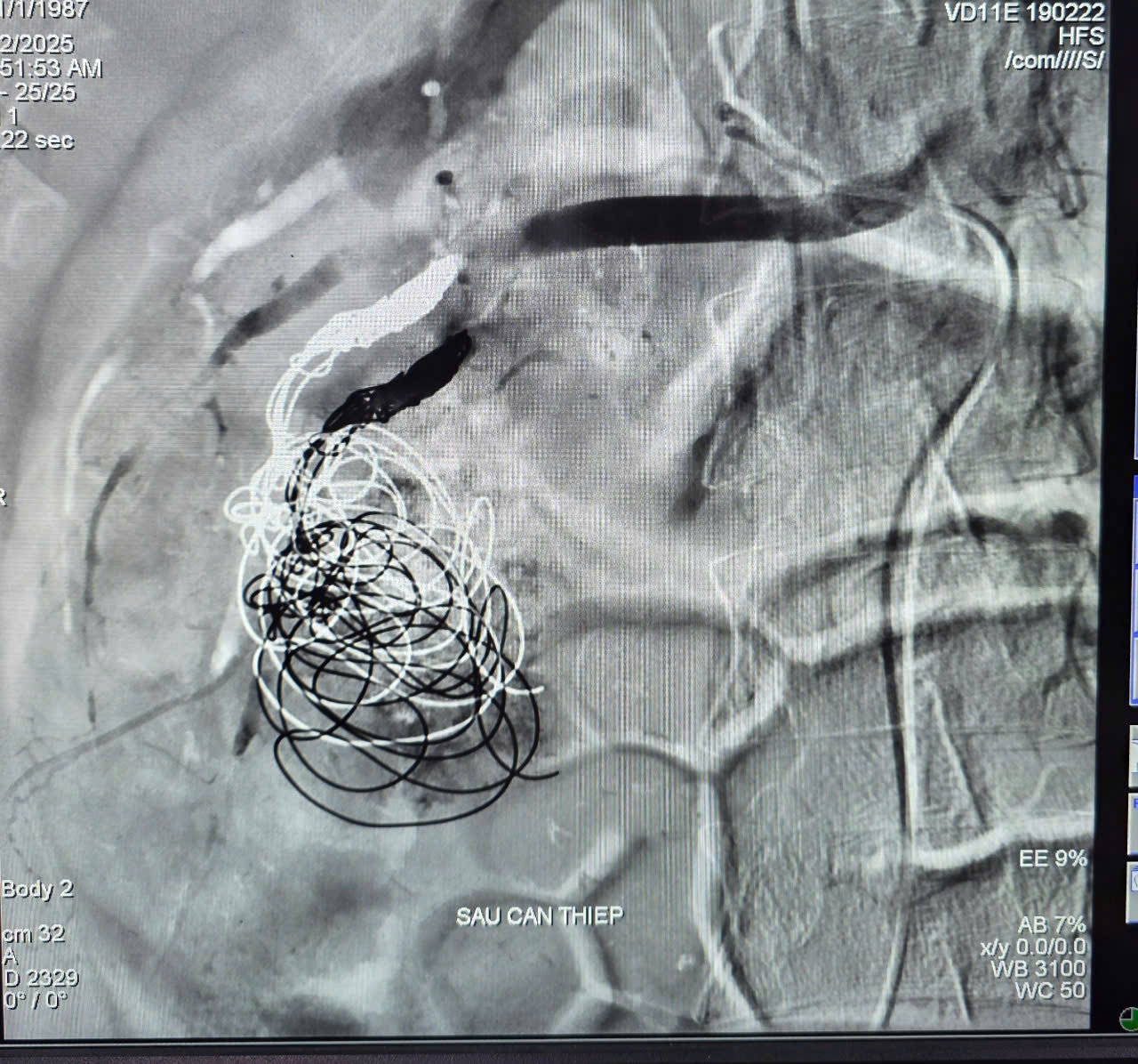 Cần Thơ: Cứu sống bệnh nhân chấn thương thận có biến chứng ổ giả phình mạch lớn xuất huyết