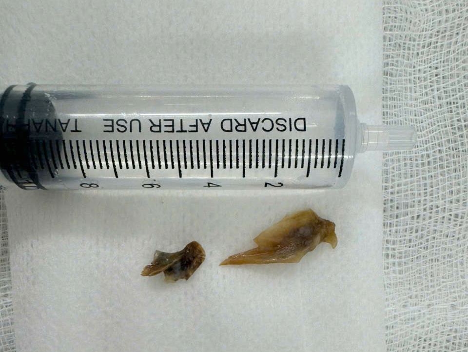 Nội soi phế quản ống mềm lấy thành công 2 mẫu xương trong phổi của bệnh nhân