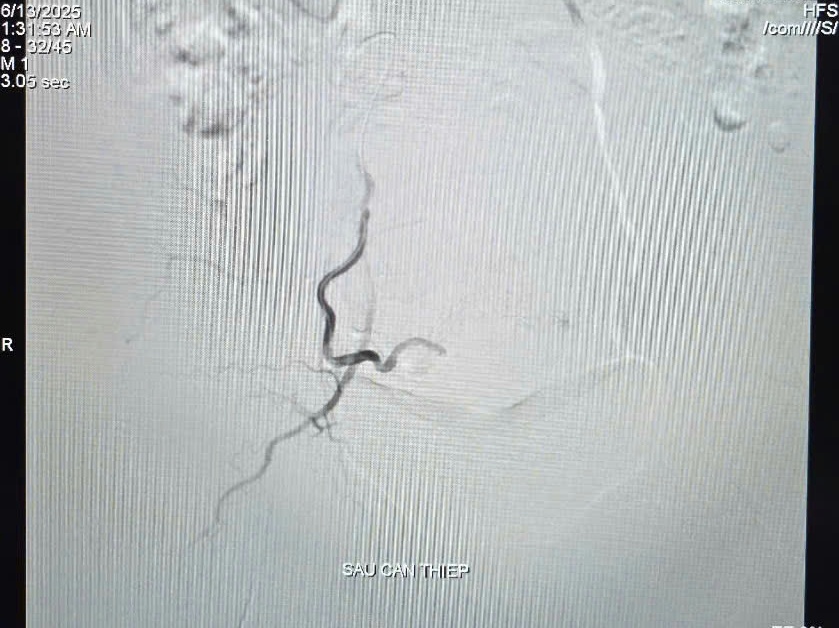 Phối hợp liên chuyên khoa cứu sống bệnh nhân xuất huyết tử cung