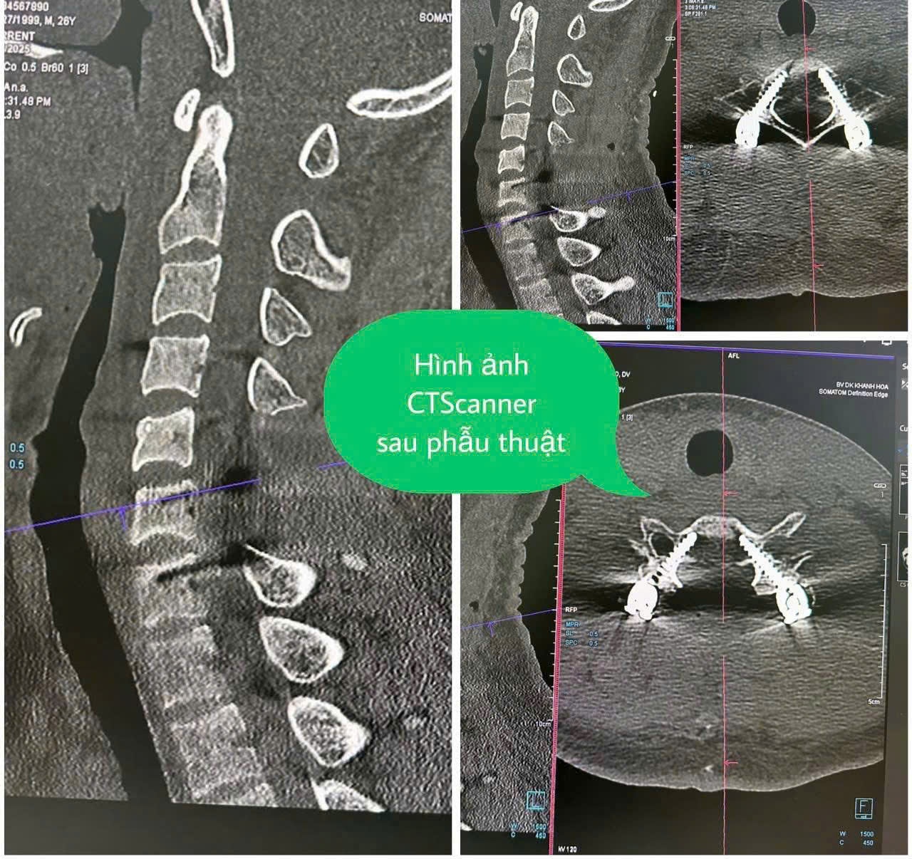 Bệnh nhân Hàn Quốc bị chấn thương cột sống cổ nghiêm trọng được phẫu thuật thành công