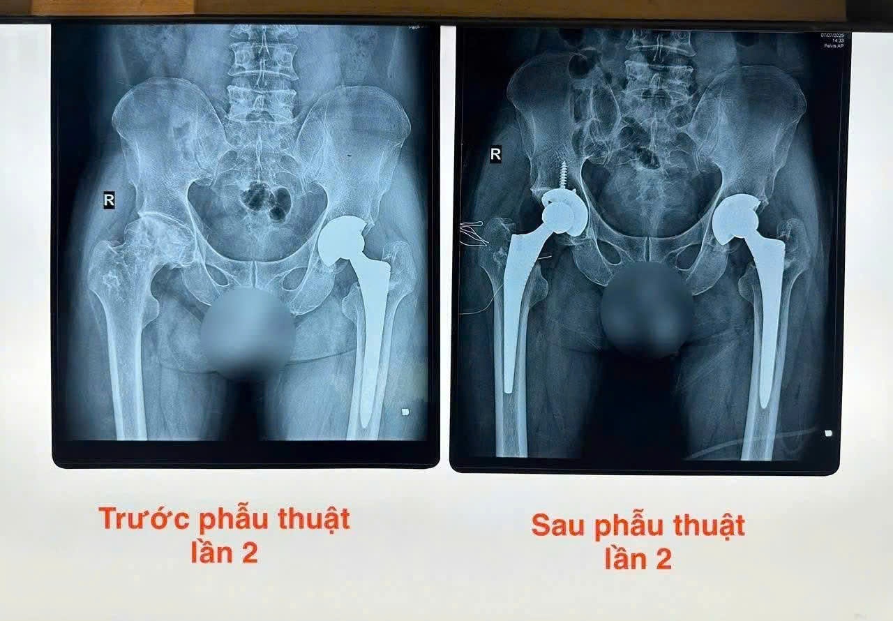 BVĐK Khánh Hoà thực hiện thành công hai lần thay khớp háng cho bệnh nhân BVĐK Khánh Hoà thực hiện thành công hai lần thay khớp háng cho bệnh nhân